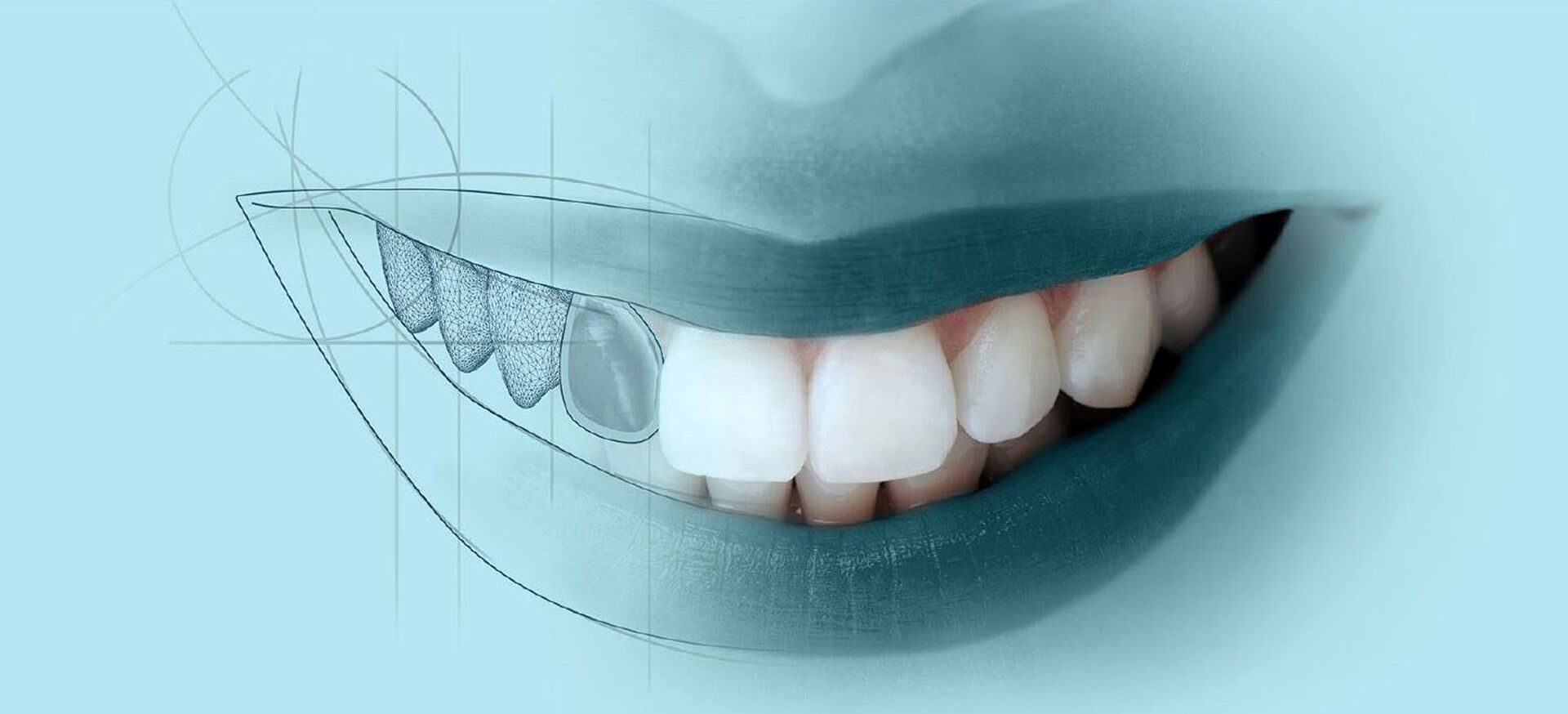 Diseño prótesis dentales mediante tecnología Cad-Cam - Clínica Las ...